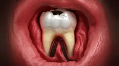 What Food Can You Eat with an Abscessed Tooth?