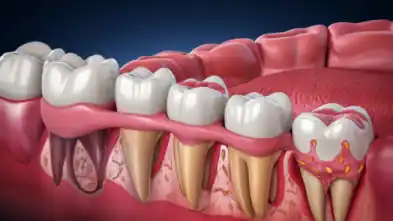 Understanding Gum Recession